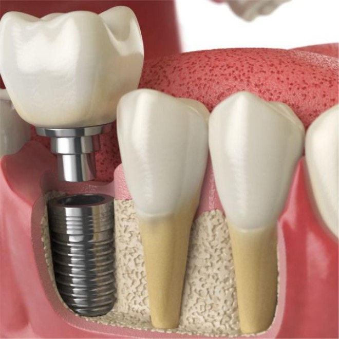 images/2022/09/implante-dentario.jpg