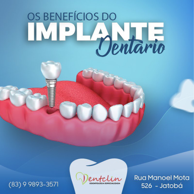 images/2022/09/implantes-dentarios.png